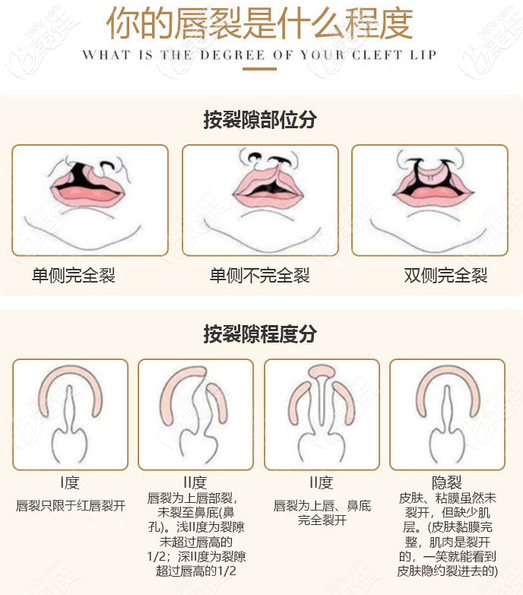 想知道唇腭裂可以完全修复好吗谁有唇腭裂完全修复后图片参考下