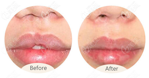 唇腭裂完全修复后图片