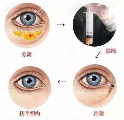 做完内切眼袋后泪沟凹陷明显可以自体脂肪填充吗会不会出现偏移