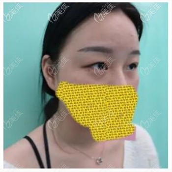 做双眼皮手术前 做双眼皮手术前