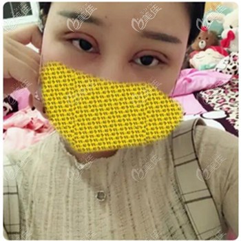 内双做双眼皮效果图 内双做双眼皮效果图