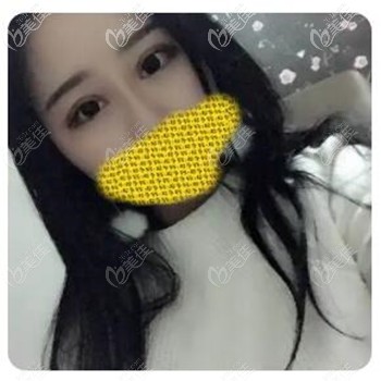 全切和埋线哪个漂亮?来份内双的我选择割双眼皮3个月后效果图帮你做选择