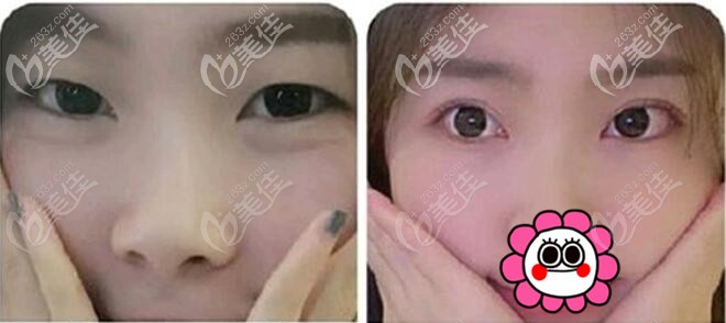 重庆军美胡金香双眼皮