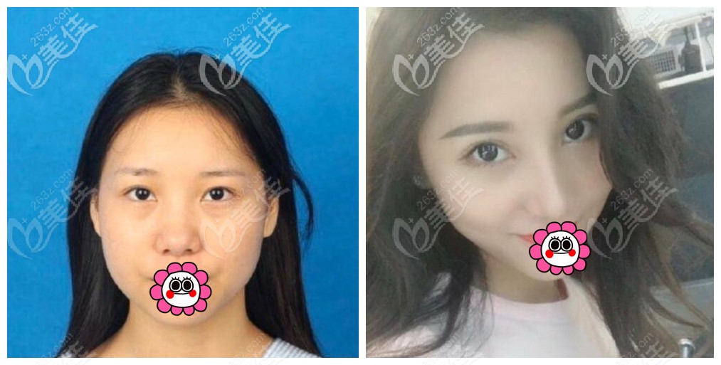 重庆军美章小平隆鼻