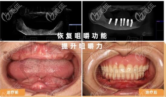 请看重度牙周炎顾客在上海曙康做ALLON6全口即刻种植牙的案例及价格