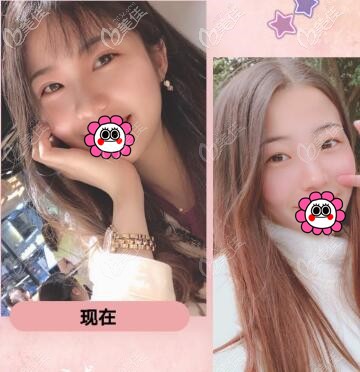 重庆华美李富强双眼皮