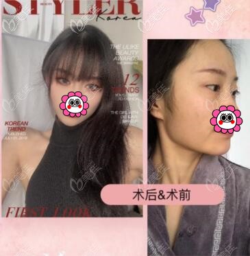 重庆华美潘宝华下颌角手术