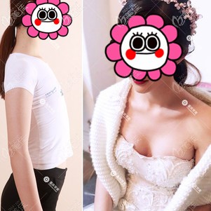 重庆华美严文辉隆胸