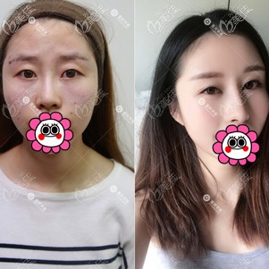 重庆华美李任隆鼻