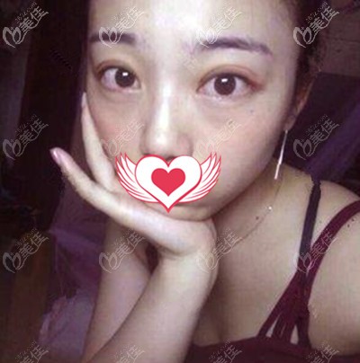 这是手术一周的照片