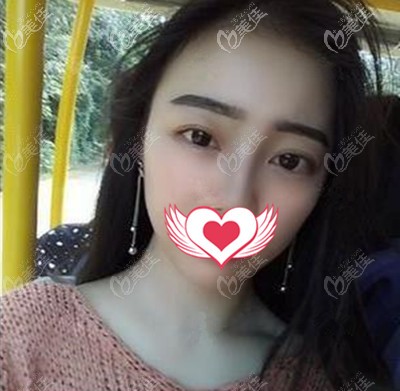 做完手术一个月照片