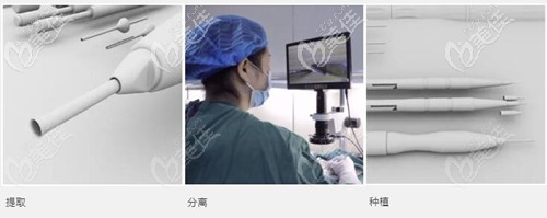 新生3D植发技术原理 新生3D植发技术原理