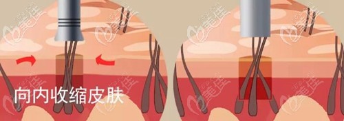 3D植发拢吸提取原理 3D植发拢吸提取原理