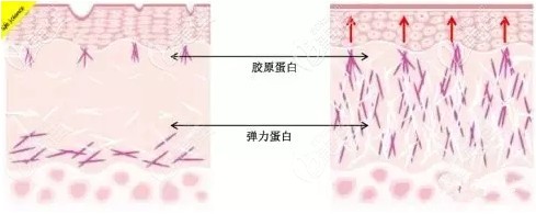埋线失败修复术后恢复平整
