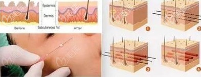 埋线失败修复手术