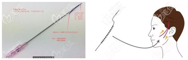 术中要是采用的大V线