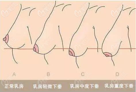 胸部下垂的程度