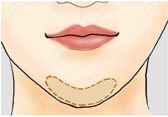 注射丰下巴