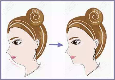 注射丰下巴效果图