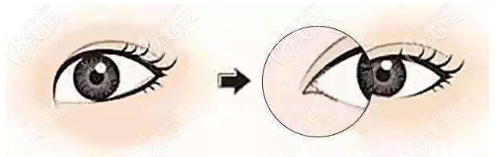 开内眼角示意图