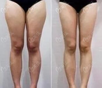 吸脂瘦大腿前后对比照