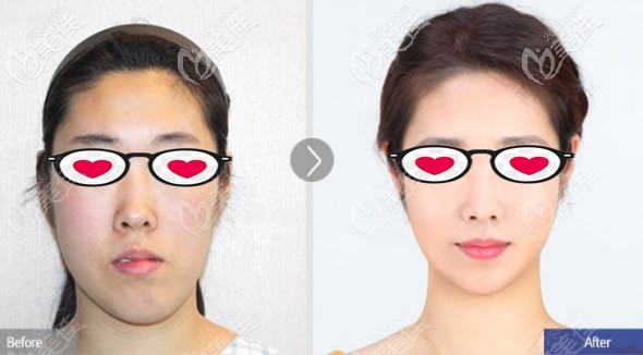 鞋拔子脸矫正前后对比照片