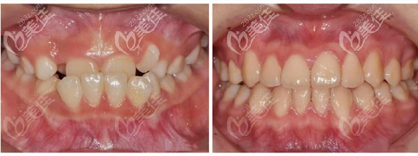 成都茁悦口腔陆开盛院长地包天案例