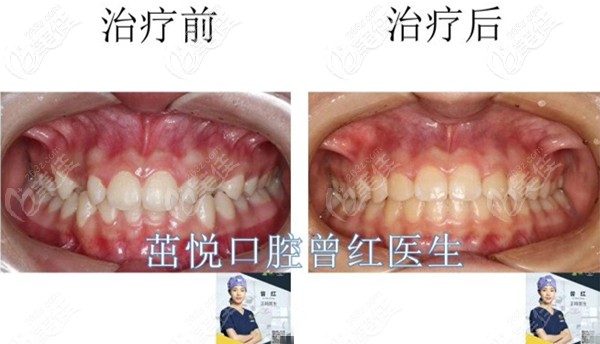 成都茁悦口腔曾红医生的牙列不齐矫正案例