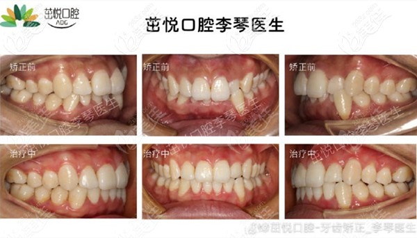 成都茁悦口腔李琴医生的深覆合矫治案例