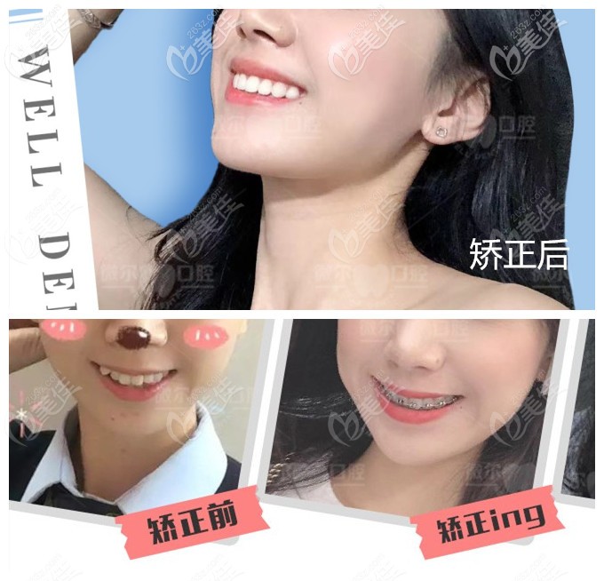 齿矫正前后对比照 齿矫正前后对比照