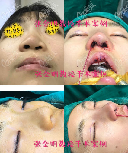 广州张金明唇裂鼻畸形修复案例