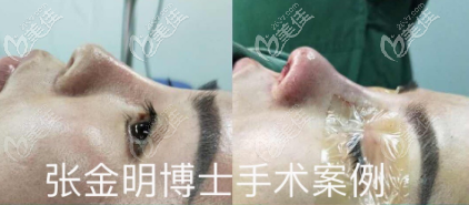 通过六组张金明医生鼻修复案例来看广州中科美张金明做鼻子怎么样好不好