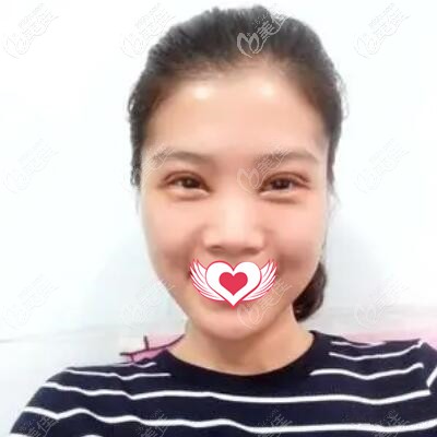 割双眼皮术后第3天