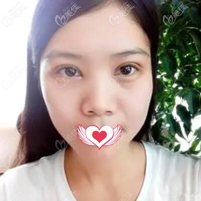 割双眼皮一周拆线