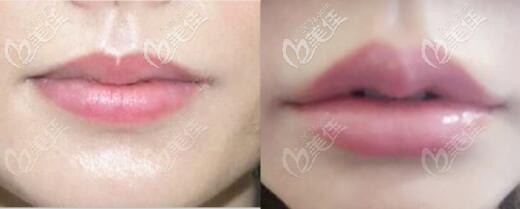 瑞蓝玻尿酸丰唇前后对比效果照