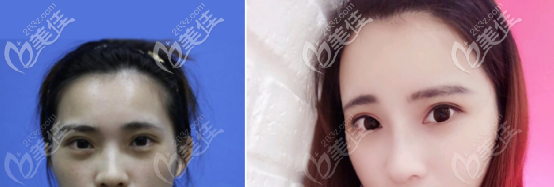 玻尿酸隆鼻案例 玻尿酸隆鼻案例