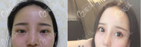 玻尿酸隆鼻案例 玻尿酸隆鼻案例