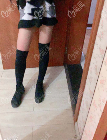 如果你问我济南哪家医院做吸脂好？请参考宝琳娜大腿吸脂术前术后对比图