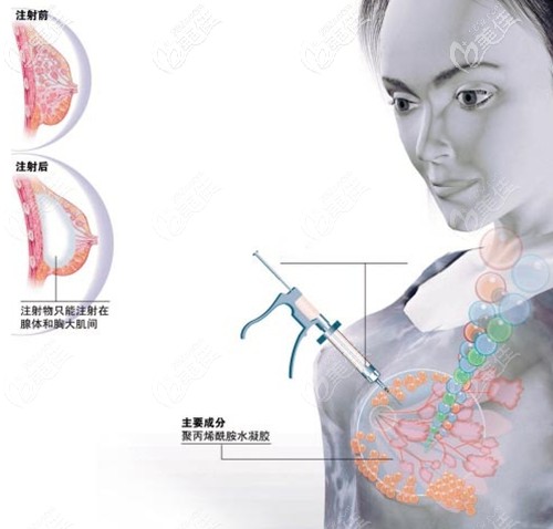 广州海峡是广州专门取胸部奥美定的医院 广州海峡是广州专门取胸部奥美定的医院