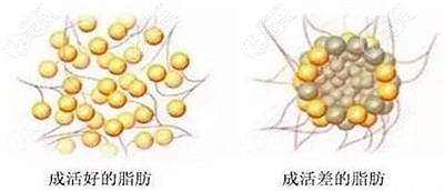 全脸脂肪填充后可能出现的副作用