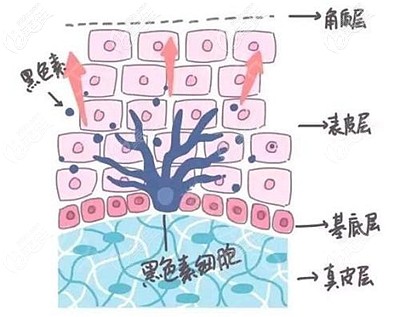 脂肪填充后脸变黑的原因