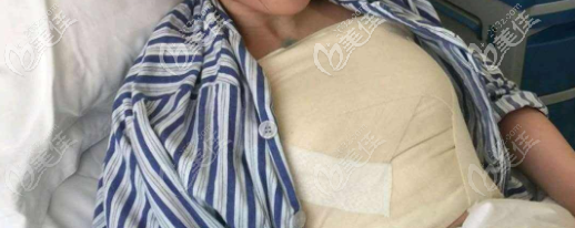 济南艺星假体隆胸术后当天 济南艺星假体隆胸术后当天