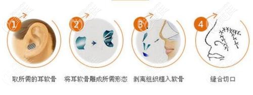 隆鼻失败修复的耳软骨可以二次使用