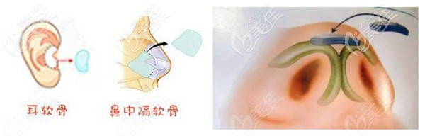 用耳软骨和鼻中隔软骨同时进行修复鼻尖