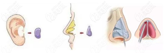 耳软骨垫鼻尖会有吸收