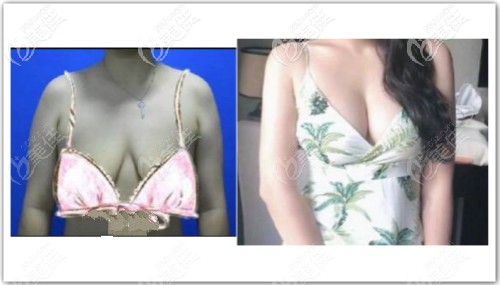 乳房悬吊提升一年效果图片