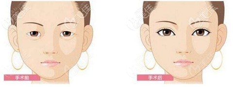 眼综合效果对比