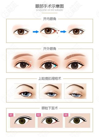 眼综合手术项目