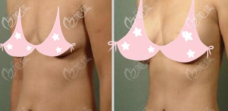 假体隆胸后效果对比