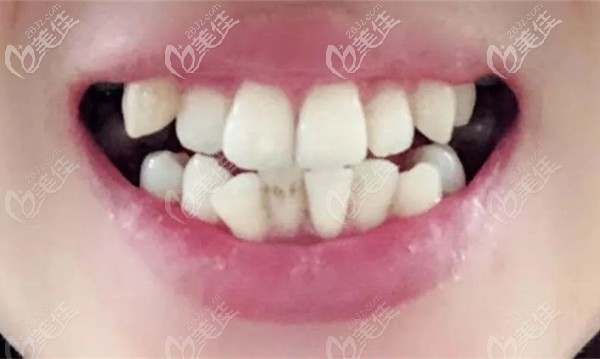 小姐姐在<!--<i data=20240703-sp></i>-->齿科整牙前的口内照 小姐姐在<!--<i data=20240703-sp></i>-->齿科整牙前的口内照